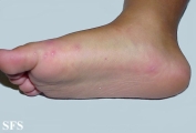 hand-food-and-mouth disease