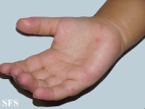 hand-food-and-mouth disease