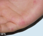 hand-food-and-mouth disease