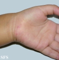 hand-food-and-mouth disease