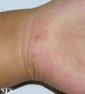 hand-food-and-mouth disease