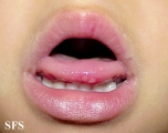 hand-food-and-mouth disease