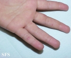 hand-food-and-mouth disease