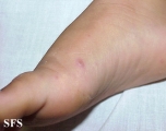 hand-food-and-mouth disease