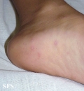 hand-food-and-mouth disease