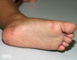 hand-food-and-mouth disease