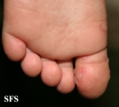 hand-food-and-mouth disease