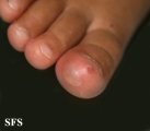 hand-food-and-mouth disease