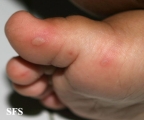 hand-food-and-mouth disease