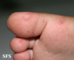 hand-food-and-mouth disease