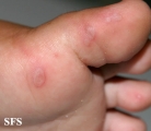 hand-food-and-mouth disease