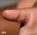 hand-food-and-mouth disease