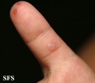 hand-food-and-mouth disease