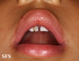 hand-food-and-mouth disease