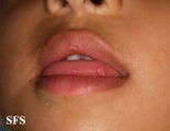 hand-food-and-mouth disease