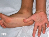 hand-food-and-mouth disease