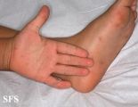 hand-food-and-mouth disease
