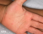 hand-food-and-mouth disease