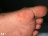 hand-food-and-mouth disease