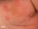 hand-food-and-mouth disease