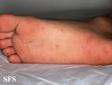 hand-food-and-mouth disease