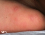 hand-food-and-mouth disease