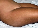 incontinentia pigmenti achromians of ito