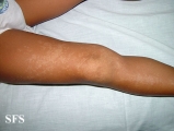 incontinentia pigmenti achromians of ito