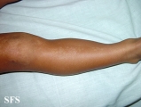 incontinentia pigmenti achromians of ito