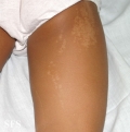 incontinentia pigmenti achromians of ito