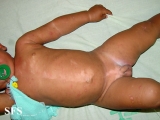 incontinentia pigmenti achromians of ito