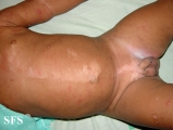 incontinentia pigmenti achromians of ito