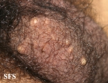 scrotal cyst