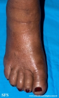 leprosy lepromatous