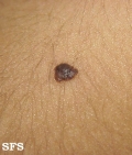 melanocytic naevi intradermal