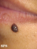 melanocytic naevi intradermal