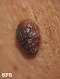 melanocytic naevi intradermal