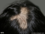 trichotillomania