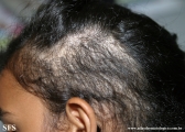trichotillomania