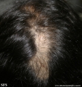 trichotillomania