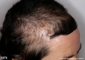 trichotillomania