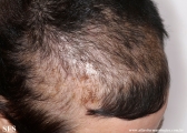 trichotillomania