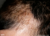 trichotillomania