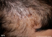 trichotillomania