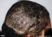 trichotillomania