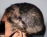 trichotillomania
