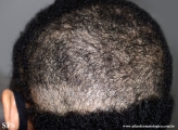 trichotillomania