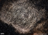 trichotillomania