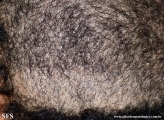 trichotillomania
