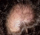 trichotillomania